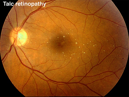 retinopatia de talco